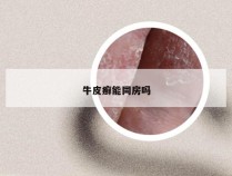 牛皮癣能同房吗