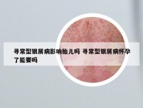 寻常型银屑病影响胎儿吗 寻常型银屑病怀孕了能要吗