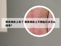 银屑病身上有了 银屑病身上不断起红点怎么回事?