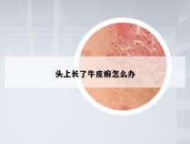 头上长了牛皮癣怎么办