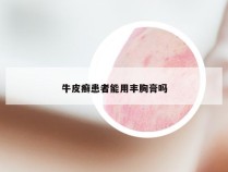 牛皮癣患者能用丰胸膏吗