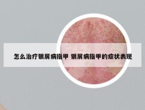 怎么治疗银屑病指甲 银屑病指甲的症状表现