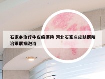 石家乡治疗牛皮癣医院 河北石家庄皮肤医院治银屑病泡浴