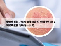 喉咙疼引起了银屑病能根治吗 喉咙疼引起了银屑病能根治吗吃什么药