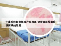 牛皮癣吃郁金银屑片有用么 郁金银屑片治疗银屑病的效果