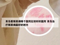 青岛看银屑病哪个医院比较好的医院 青岛治疗银屑病最好的地方
