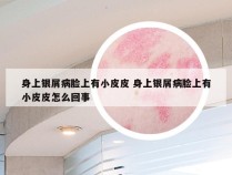 身上银屑病脸上有小皮皮 身上银屑病脸上有小皮皮怎么回事