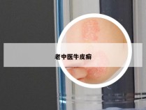老中医牛皮癣