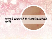 深圳哪家医院治牛皮癣 深圳哪家医院做完紧缩术好