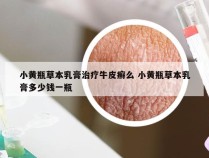 小黄瓶草本乳膏治疗牛皮癣么 小黄瓶草本乳膏多少钱一瓶