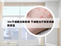 301干细胞治银屑病 干细胞治疗银屑病最新报道