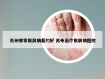 苏州哪家银屑病看的好 苏州治疗银屑病医院