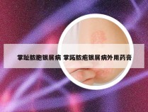 掌趾脓胞银屑病 掌跖脓疱银屑病外用药膏