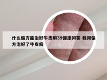 什么偏方能治好牛皮癣39健康问答 我用偏方治好了牛皮癣
