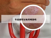 牛皮癣可以每天喝茶吗