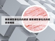 银屑病性脊柱炎的症状 银屑病性脊柱炎的症状有哪些