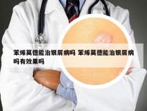 苯烯莫德能治银屑病吗 苯烯莫德能治银屑病吗有效果吗