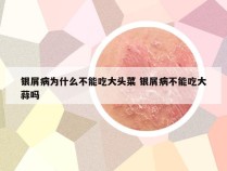 银屑病为什么不能吃大头菜 银屑病不能吃大蒜吗