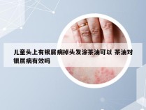 儿童头上有银屑病掉头发涂茶油可以 茶油对银屑病有效吗