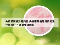 头皮银屑病外用药膏 头皮银屑病外用药膏治疗外观好了 还需要巩固吗