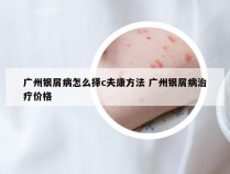 广州银屑病怎么择c夫康方法 广州银屑病治疗价格