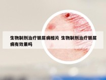 生物制剂治疗银屑病相片 生物制剂治疗银屑病有效果吗