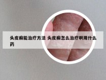 头皮癣能治疗方法 头皮癣怎么治疗啊用什么药