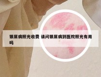 银屑病照光收费 请问银屑病到医院照光有用吗