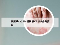 银屑病ca199 银屑病CA199会升高吗