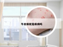 牛皮癣就是癣病吗