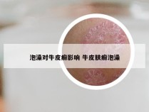 泡澡对牛皮癣影响 牛皮肤癣泡澡