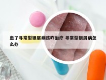 患了寻常型银屑病该咋治疗 寻常型银屑病怎么办