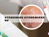 关节性银屑病的表现 关节性银屑病的表现有哪些