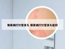 银屑病打针管多久 银屑病打针管多久能好