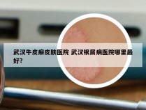 武汉牛皮癣皮肤医院 武汉银屑病医院哪里最好?