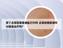 得了点滴型银屑病能打针吗 点滴状银屑病可以输液治疗吗?