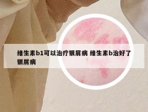 维生素b1可以治疗银屑病 维生素b治好了银屑病