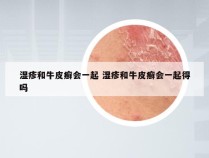 湿疹和牛皮癣会一起 湿疹和牛皮癣会一起得吗