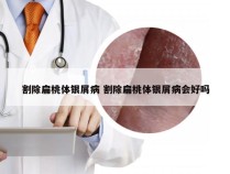 割除扁桃体银屑病 割除扁桃体银屑病会好吗