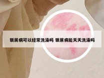 银屑病可以经常洗澡吗 银屑病能天天洗澡吗