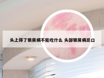 头上得了银屑病不能吃什么 头部银屑病忌口