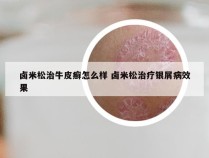 卤米松治牛皮癣怎么样 卤米松治疗银屑病效果
