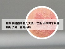 银屑病的孩子要几天洗一次澡 小孩得了银屑病好了用一直吃药吗