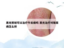 黑光照射可以治疗牛皮癣吗 黑光治疗对银屑病怎么样