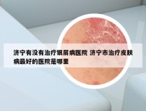 济宁有没有治疗银屑病医院 济宁市治疗皮肤病最好的医院是哪里
