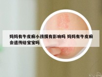 妈妈有牛皮癣小孩摸有影响吗 妈妈有牛皮癣会遗传给宝宝吗