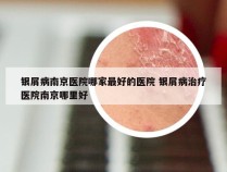 银屑病南京医院哪家最好的医院 银屑病治疗医院南京哪里好