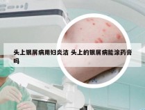 头上银屑病用妇炎洁 头上的银屑病能涂药膏吗