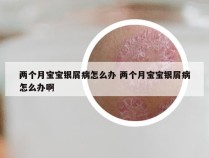 两个月宝宝银屑病怎么办 两个月宝宝银屑病怎么办啊