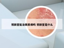 初肤堂能治银屑病吗 初肤堂是什么